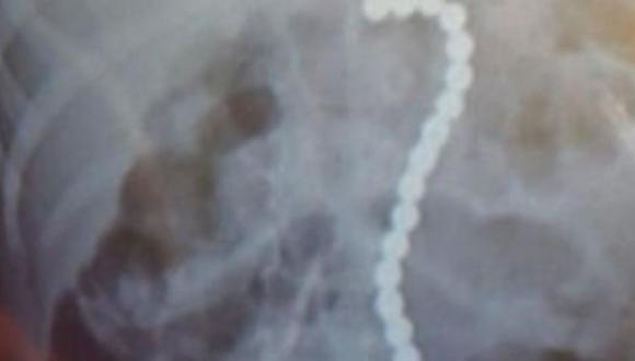 Imagen de una radiografía de Konin Arrington, de 2 años. (Captura de pantalla/Hannah Arrington/WESH).