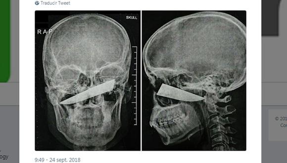 Sudáfrica: Joven pasó cuatro días con un cuchillo enterrado en la cabeza.