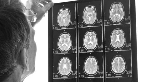 Factores que aumentan el riesgo de sufrir un derrame cerebral