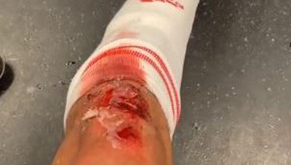 Álvarez y su rodilla ensangrentada tras el Harecles-Ajax. (Foto: Instagram @edsonnalvarez)