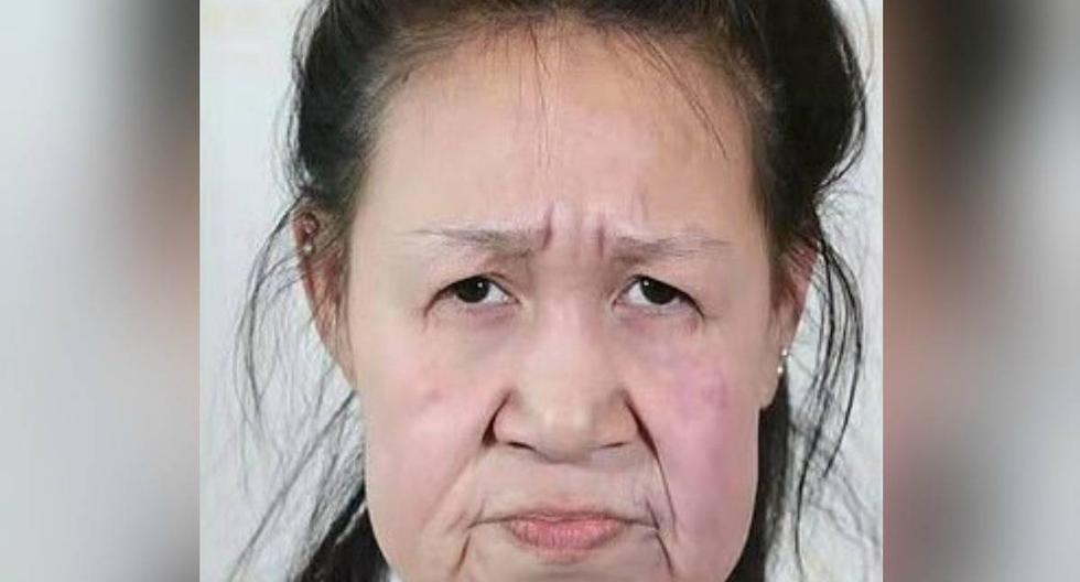 Xiaofeng sufre progeria, enfermedad que da la apariencia de un anciano. (Foto: Shenyang Sunline Plastic Surgery Hospital)