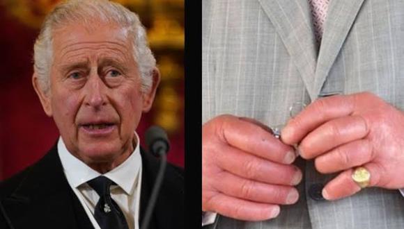 Por qué el rey Carlos III tiene las manos hinchadas tras muerte de la reina Isabel II