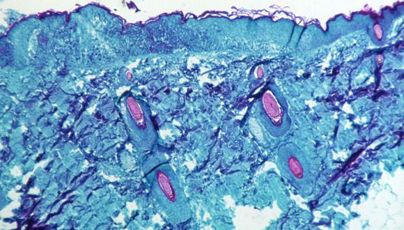 Una sección de tejido de la piel, extraída de una lesión en la piel de un mono, que había sido infectado con el virus de la viruela del mono, se ve con un aumento de 50X en el cuarto día del desarrollo de la erupción en 1968.