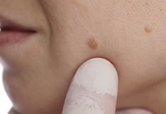 ¿Qué es el melasma y cómo afecta tu piel?