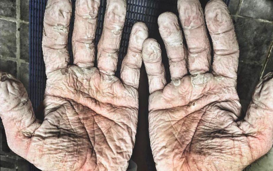 Así quedaron las manos un doble campeón olímpico de remo. Foto: Instagram