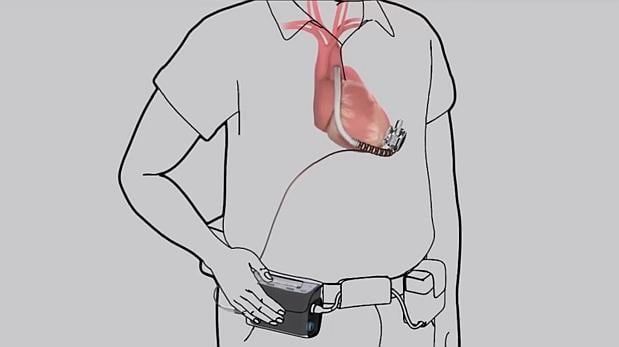 Implantan corazón mecánico como alternativa al trasplante