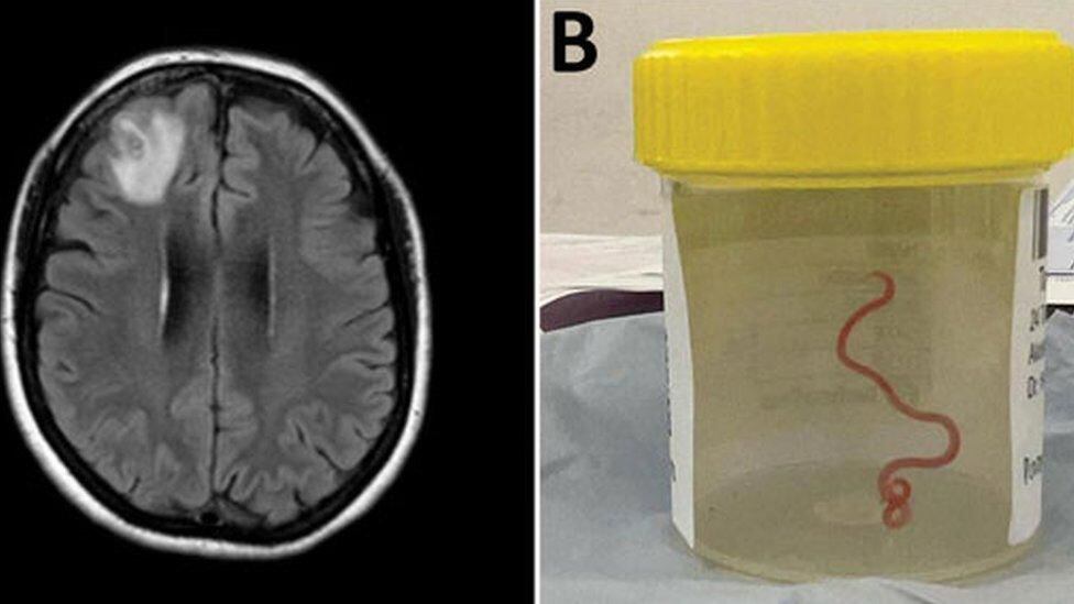 A brain scan and the extracted nematode in a sample vial, (ANU).