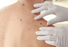 Cáncer de piel: conoce cómo detectar y prevenir el melanoma cutáneo maligno