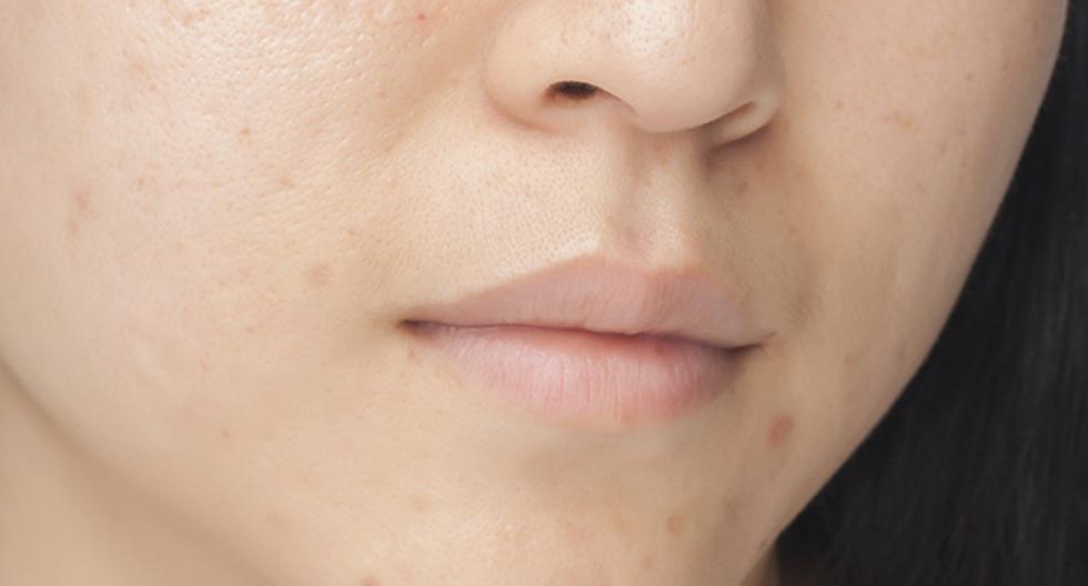 Sigue estos consejos para evitar las manchas en el rostro. (Foto: IStock)