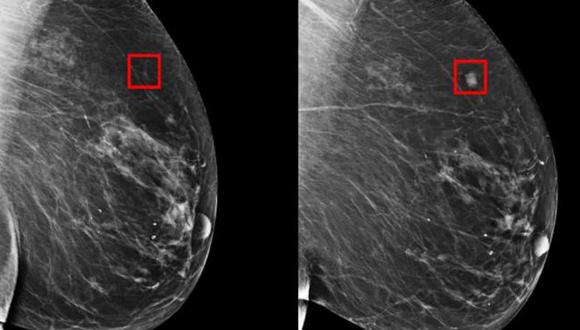 Inteligencia artificial sería capaz de detectar el cáncer de mama 4 años antes de formarse. (Foto: Twitter @InformaCosmos)