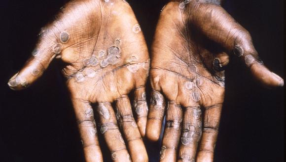 Las palmas de las manos de un paciente con viruela del simio de Lodja, una ciudad ubicada dentro de la Zona de Salud de Katako-Kombe, se ven durante una investigación de salud en la República Democrática del Congo en 1997. Fotografía tomada en 1997.