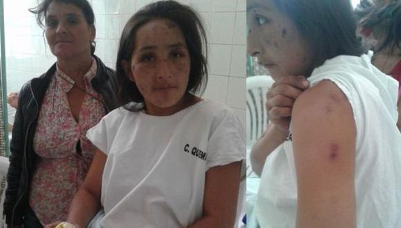 Cajamarca: ebrio quema a su pareja con 7 meses de embarazo