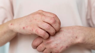 Sarampión, tosferina y más: enfermedades olvidadas reaparecen en Estados Unidos