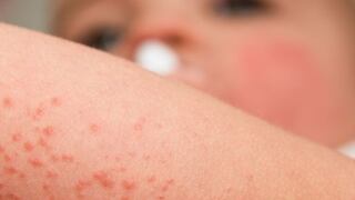 Dermatitis atópica: ¿Cuáles son sus síntomas y qué tanto afecta a los que la padecen?