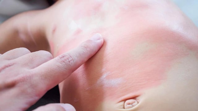 Dermatitis atópica en bebés: por qué ocurre, síntomas y tratamientos