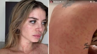 Flavia Laos rompe su silencio sobre la psoriasis: “Pensé que era varicela o intoxicación”