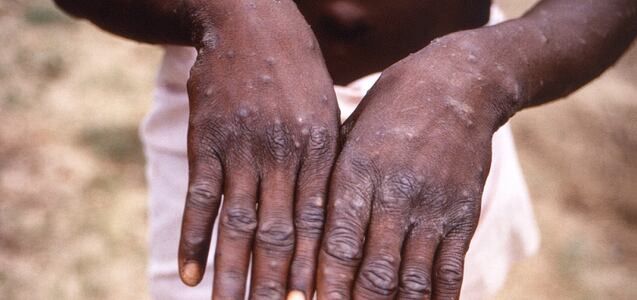 ¿Qué tan letal es la viruela del mono?