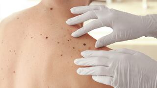 Cáncer de piel: conoce cómo detectar y prevenir el melanoma cutáneo maligno
