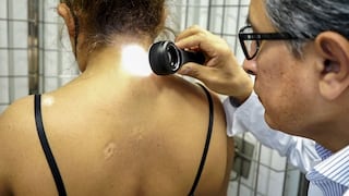 EsSalud: pacientes acceden a tratamiento que detiene avance del vitiligo 