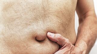 Marlon Pastrana, cirujano: estas condiciones pueden desencadenar una hernia umbilical en adultos