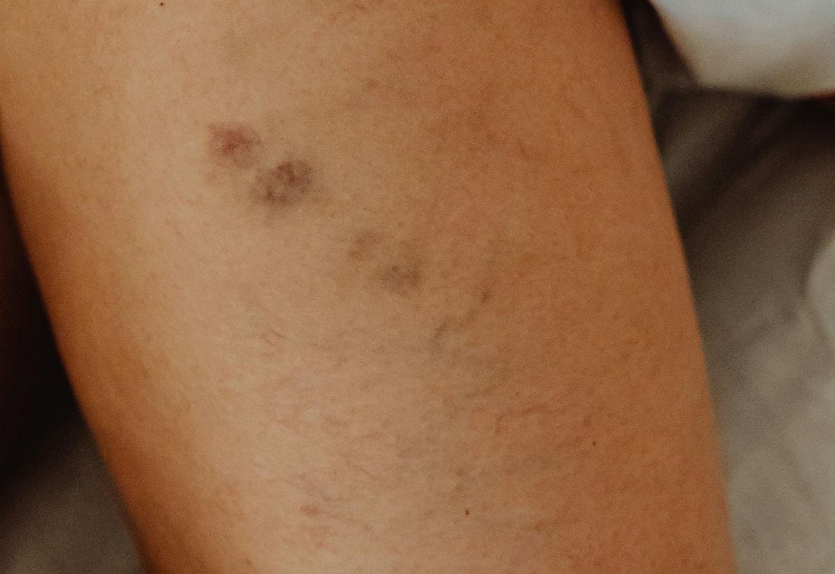 Los moretones pueden ser dolorosos, pero por lo general no son peligrosos. (Foto: Kaboompics.com / Pexels)