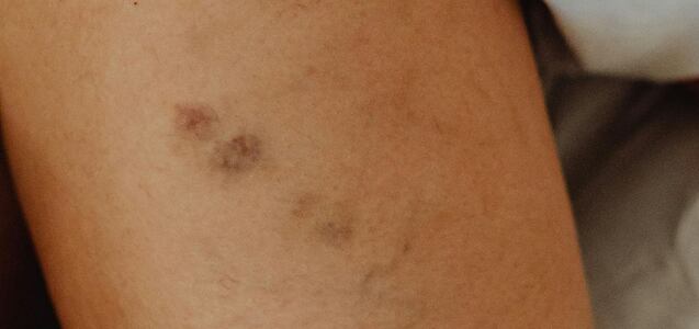 Moretones que aparecen sin golpearte: ¿son peligrosos y hay que preocuparse?