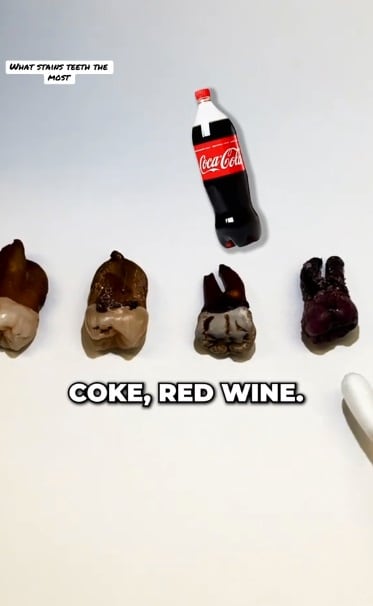 Al comparar el efecto del café, el té, la Coca-Cola y el vino tinto, el profesional señaló que el último era el mayor culpable de las manchas en los dientes. (Foto: @drmilesmadison)