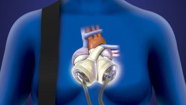 Corazón artificial puede ayudar mientras se espera implante
