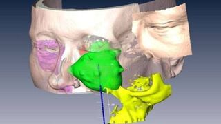 Cirujanos extrajeron parte del rostro de una mujer con cáncer y lo reconstruyeron con un escáner 3D
