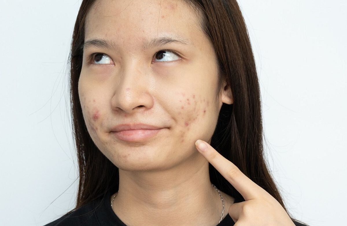 En mujeres las manchas aparecen por cambios hormonales, factores genéticos, exposición solar y también por la inflamación causada por afecciones como el acné, cicatrices o procedimientos estéticos. (Foto: Boyloso / iStock)