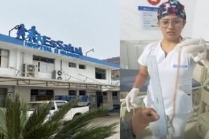 Huánuco: médicos atienden a niño de dos años que expulsó lombriz intestinal de 40 centímetros