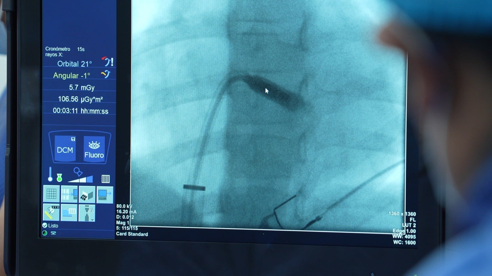 El diminuto marcapasos sin cables ya instalado en el corazón de la menor de nueve años. (Crédito: difusión).