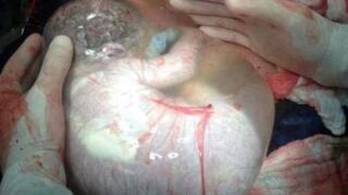 Médico publicó la foto de un bebe todavía dentro de saco amniótico