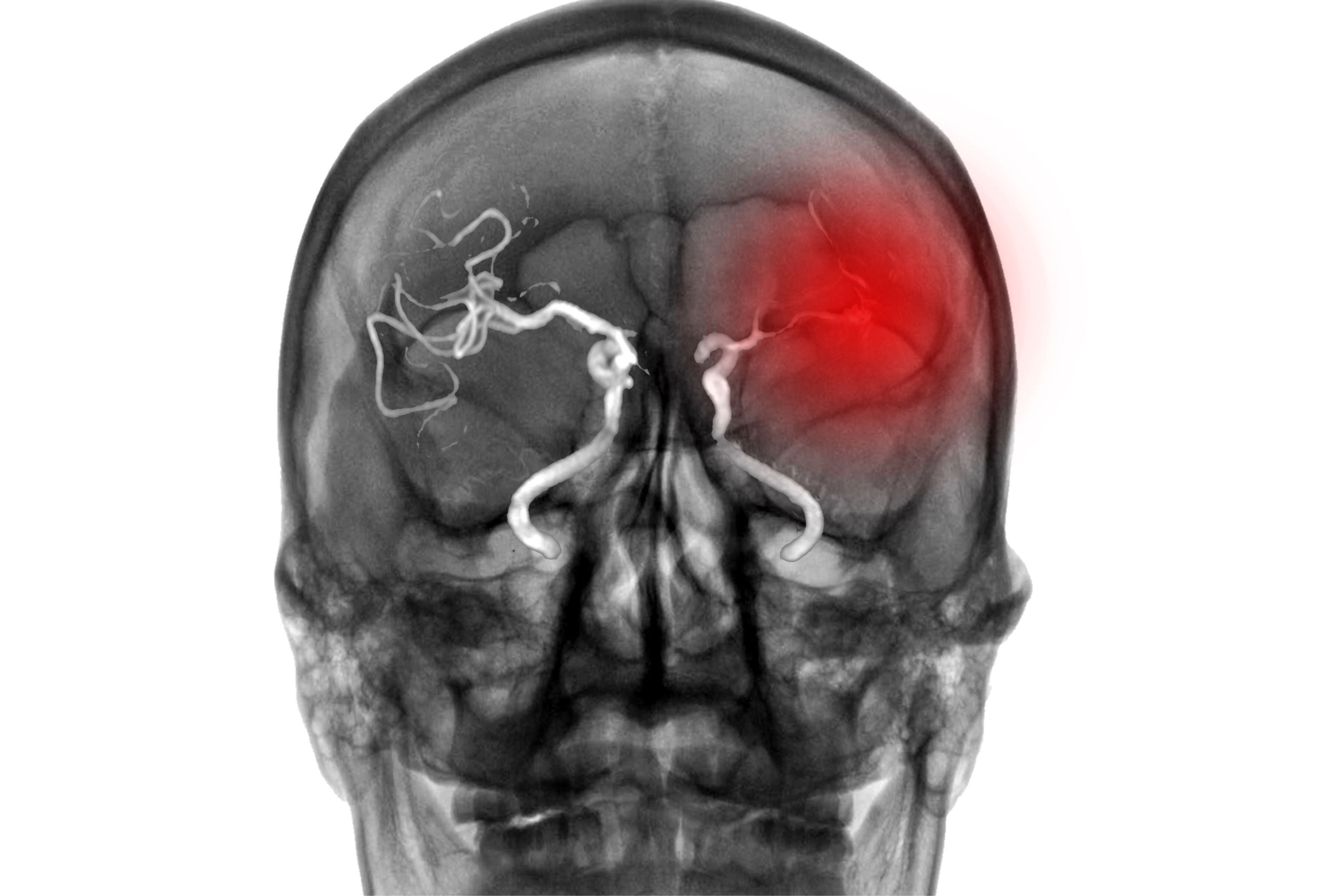 La contaminación del aire afecta varios aspectos de nuestra salud. Un equipo de investigadores en Utah decidió estudiar sus efectos en el cerebro. (Foto: sittithat tangwitthayaphum/iStock)