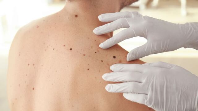 Melanoma | Dos proteínas son la clave para entender su desconocido origen