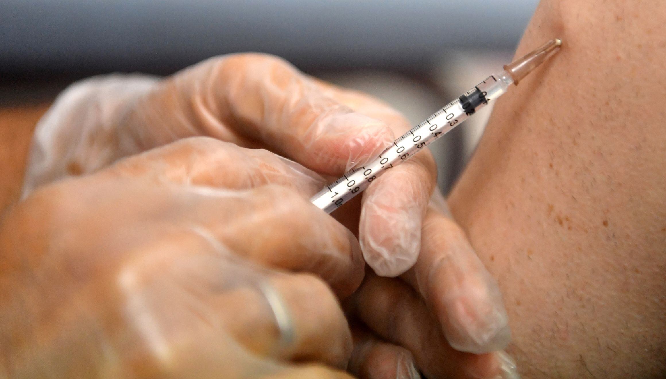 La viruela del mono, o Mpox, genera erupciones en la piel de los infectados (Foto: AFP)