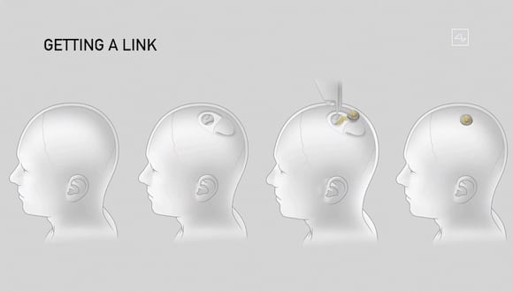 Estos son los diferentes pasos de la implantación de un dispositivo Neuralink. (Foto: AFP)