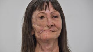 Las prótesis en 3D para víctimas del cáncer que han perdido parte del rostro | FOTOS