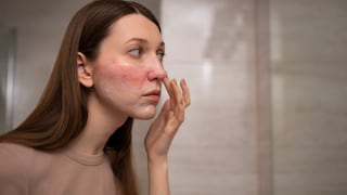 Rosácea en verano: ¿cómo prevenir y controlar los brotes de esta afección crónica de la piel?