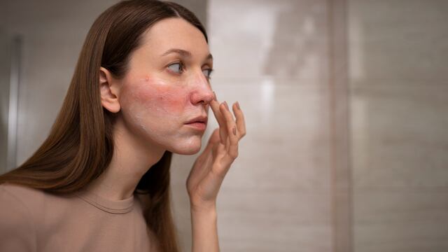 Rosácea en verano: ¿cómo prevenir y controlar los brotes de esta afección crónica de la piel?