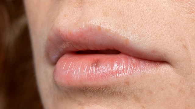 Carcinoma en el labio: ¿cuáles son los síntomas y posibles tratamientos de este tipo de cáncer?