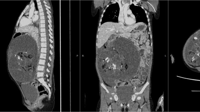 Pucallpa: niña salió de UCI tras operación de tumor gigante