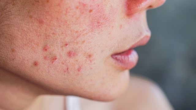 ¿Tienes acné? Dermatóloga nos da recomendaciones para cuidar y maquillar una piel acneíca
