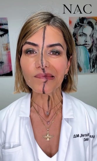 Durante la demostración, intentó mover la boca y la parte inferior de su cara. Mientras que el lado izquierdo se movía con naturalidad al hacer muecas, el derecho apenas mostraba movimiento. (Foto: @drbitaaesthetics / Instagram)