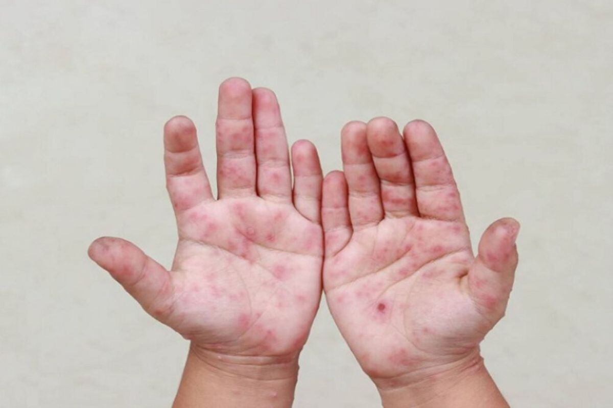 44 casos de mano, pie y boca en Lambayeque: cuarentenas en aulas y posible cierre de colegios