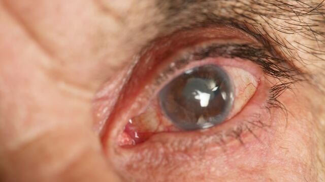 Glaucoma: ¿cuáles son las causas, factores de riesgo y los posibles tratamientos?