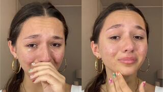 Alexia Barnechea muestra su problema con el acné: “He pasado por mucho”