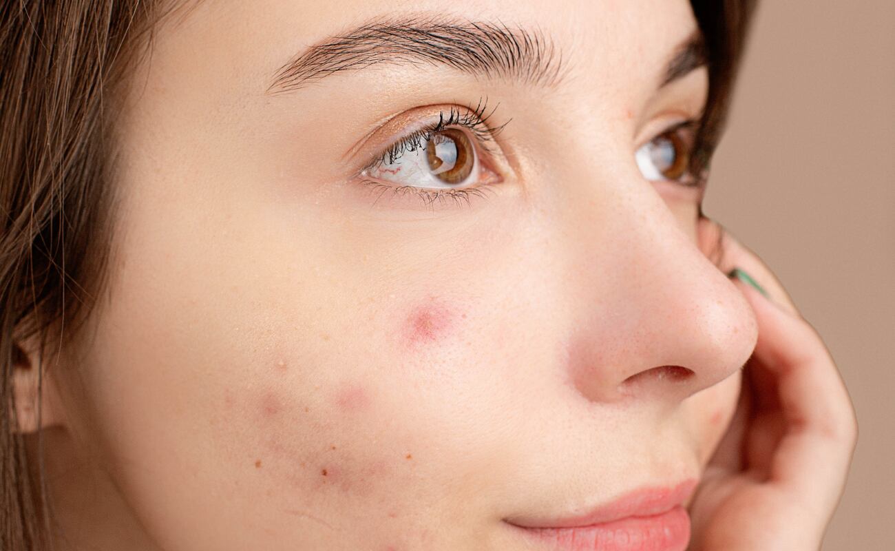 El exceso de sol puede obstruir los poros al engrosar la piel, lo que atrapa células muertas y exceso de sebo, favoreciendo los brotes de acné. Además, la deshidratación causada por el sol estimula la producción de más grasa, y la inflamación que genera puede empeorar los brotes existentes.