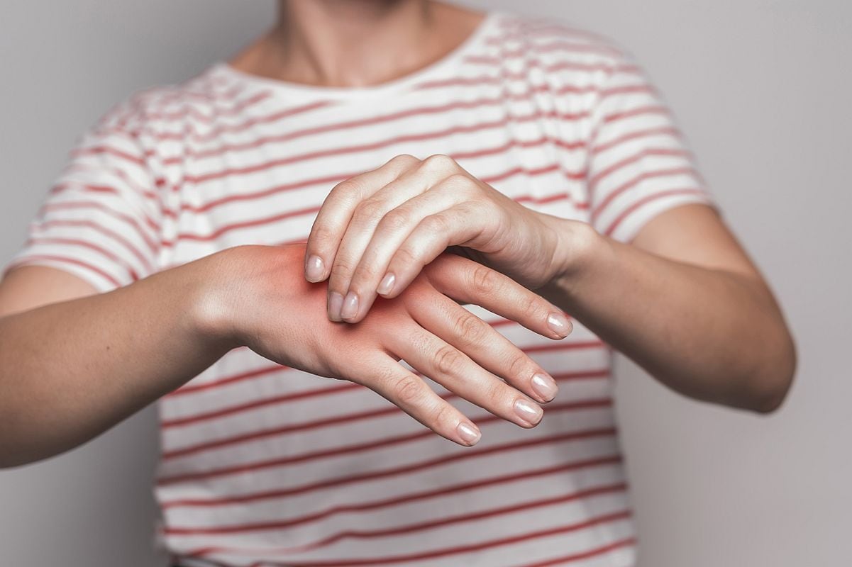 Este problema en la piel tiene como principal responsable al calor extremo. (Foto: Freepik)