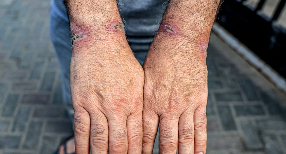 Un hombre que fue detenido junto con otros palestinos por el ejército israelí durante su operación en el norte de la Franja de Gaza y luego liberado muestra las heridas en sus muñecas en el hospital al-Najjar en Rafah, en el sur de la Franja de Gaza. (Foto de SAID KHATIB / AFP).